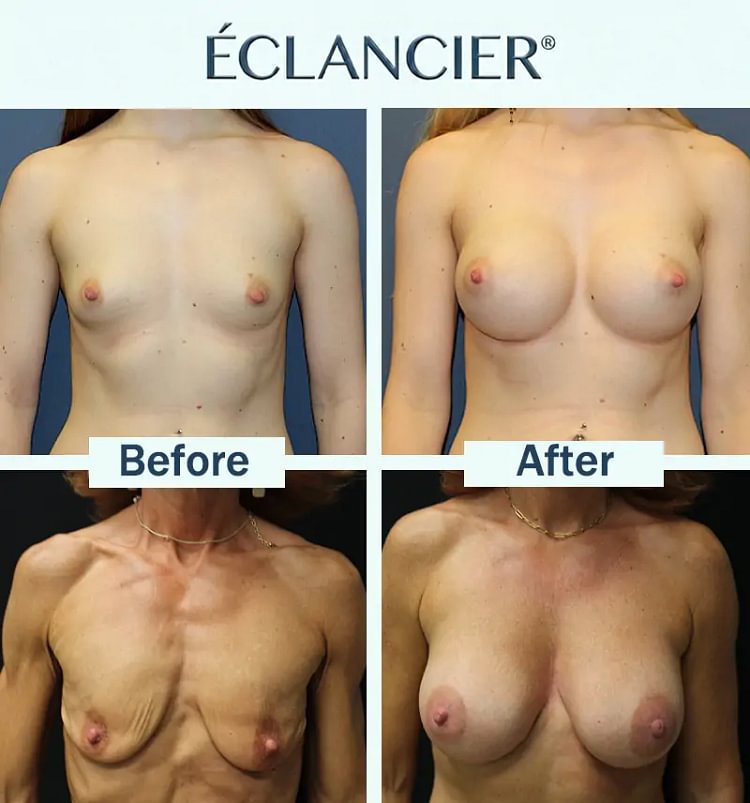 ECLANCIER® Targeted Breast Enhancement Advanced Nano Microneedle Patch - Image 4